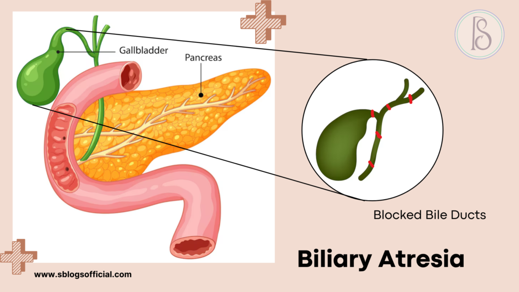 Acute Liver Failure in Infant- Biliariy Atresia 