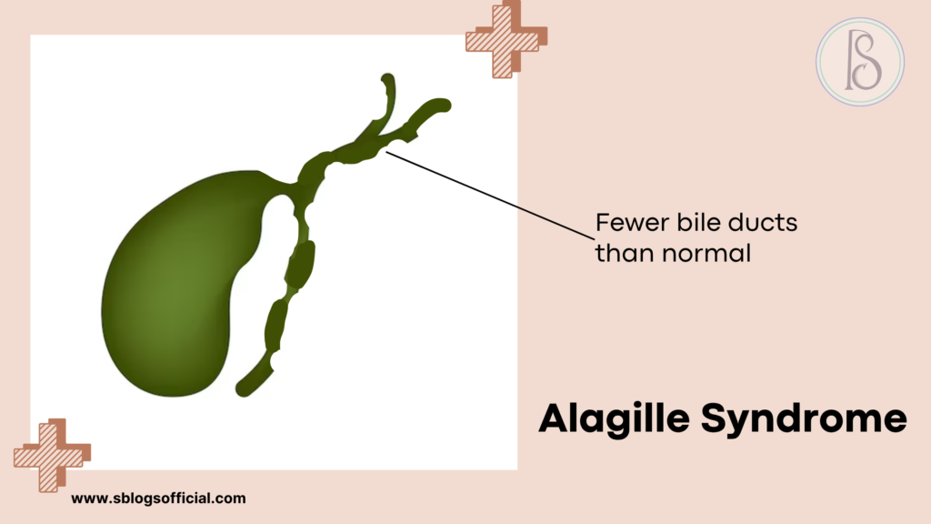 Acute Liver Failure in Infant- Alagille Syndrome (Fewer bile ducts than normal)