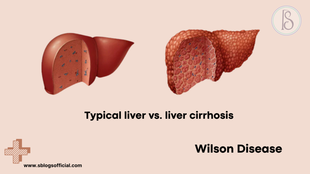 Acute Liver Failure in Infant- Typical liver vs. Liver Cirrhosis (Wilson Disease)
