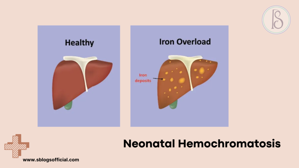 Acute Liver Failure in Infant- Neonatal Hemochromatosis 