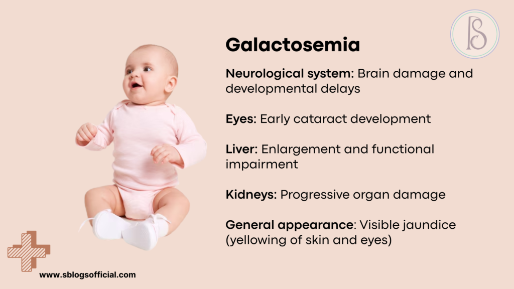 Galactosemia Complications in Infants